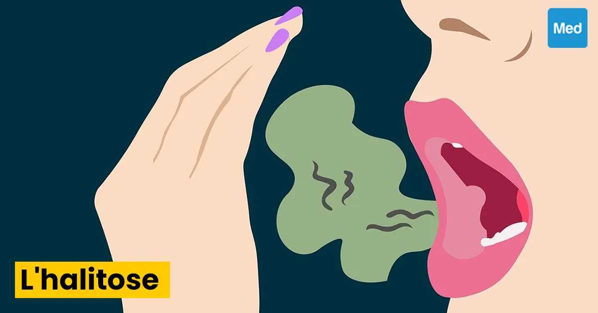 Halitose : causes, symptômes, diagnostic et traitement